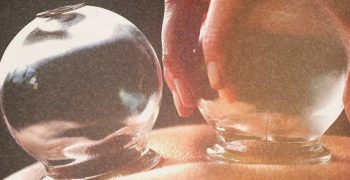 Cupping