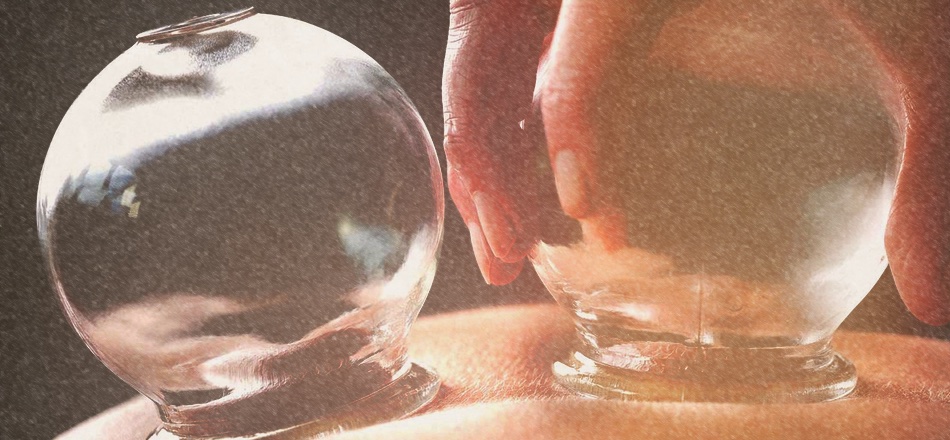 Cupping